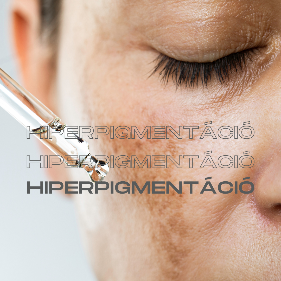 Hiperpigmentáció-miért jelennek meg a barna foltok?